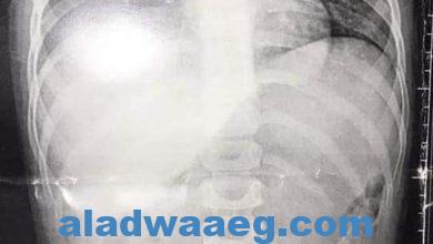 صورة اطباء مستشفي بنها الجامعي تنجح في استخراج خرزه شخشيخه أطفال من القفص الصدري لطفل