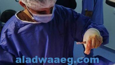 صورة نجاح اول قسطرة مستديمة لمريض غسيل كلوي بمستشفي السنبلاوين العام.